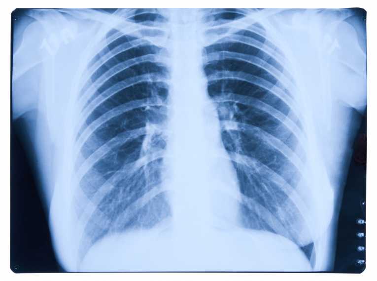 COPD Chest X-ray