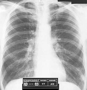 asbestosis 1/1 p/p