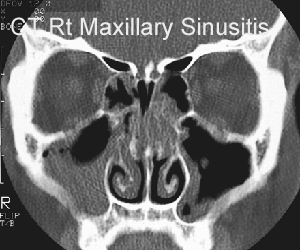 maxillary sinusitis